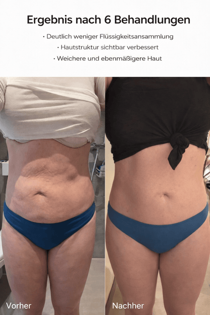 Sculptify™ Cellulite Massager